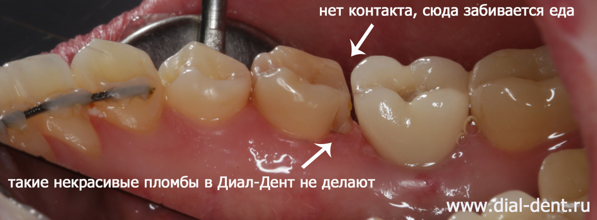 щель между зубами