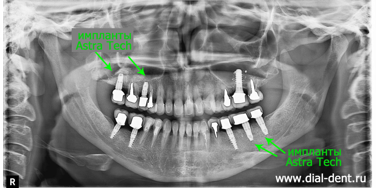 КТ зубов после имплантации