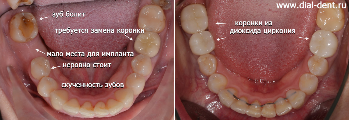 нижний зубной ряд до и после исправления прикуса, имплантации и протезирования