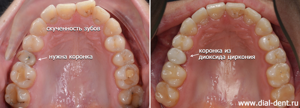 верхний зубной ряд до и после исправления прикуса и протезирования