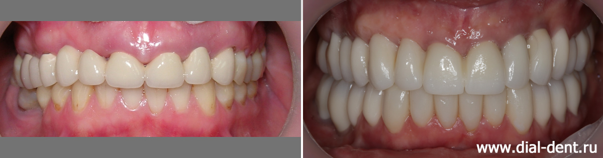 зубы до и после протезирования в правильном прикусе