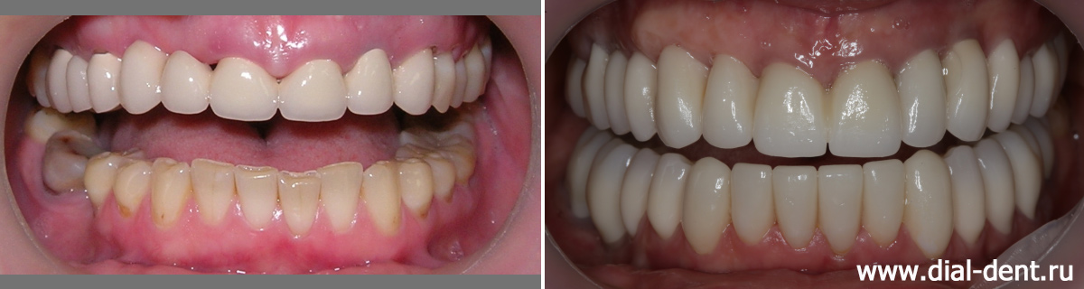 зубы до и после протезирования с поднятием прикуса