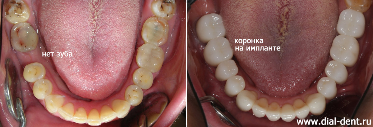 нижние зубы до и после имплантации и протезирования