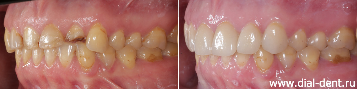 вид слева до и после протезирования зубов