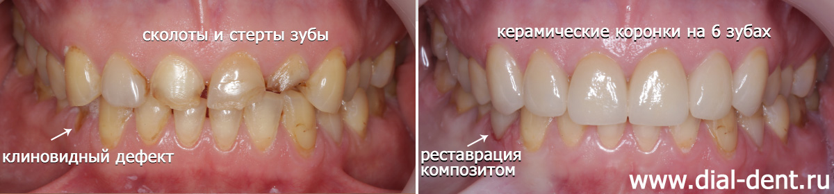 вид зубов до и после протезирования 