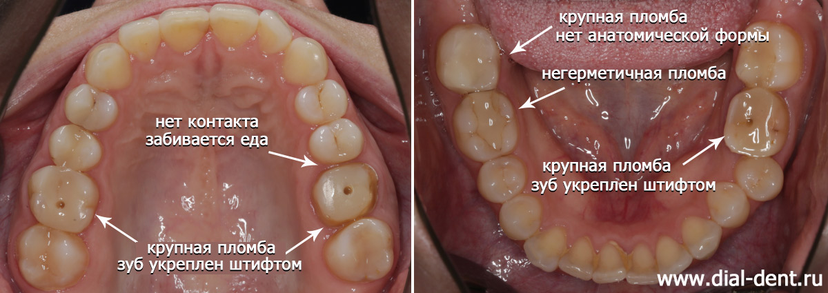зубы до протезирования