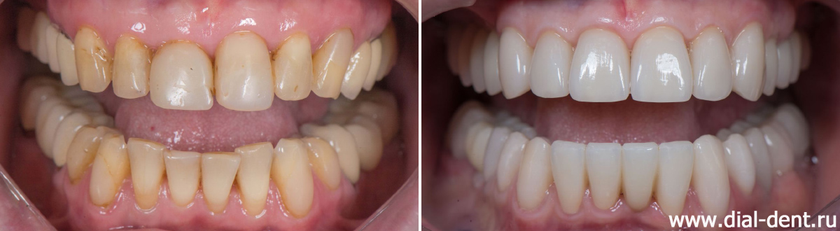 до и после комплексного лечения и протезирования зубов