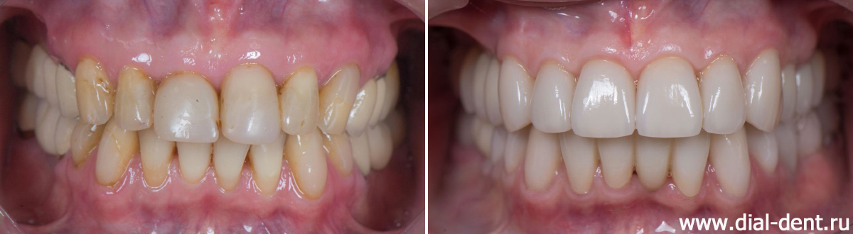вид зубов до и после протезирования