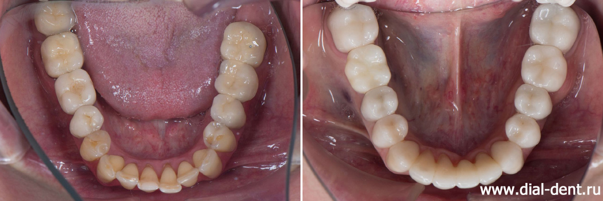 нижние зубы до и после комплексного лечения и протезирования зубов