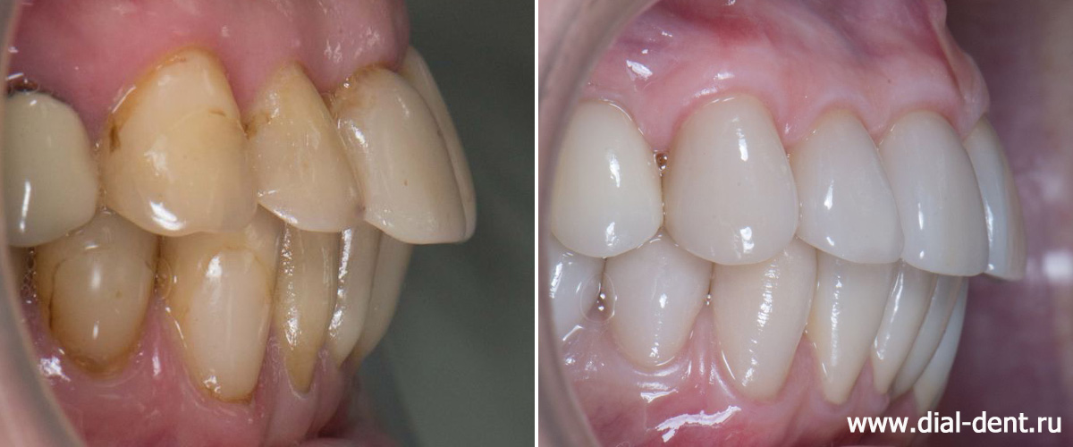 вид сбоку в прикусе до и после протезирования зубов керамикой