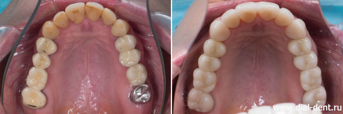 верхние зубы до и после комплексного лечения и протезирования зубов