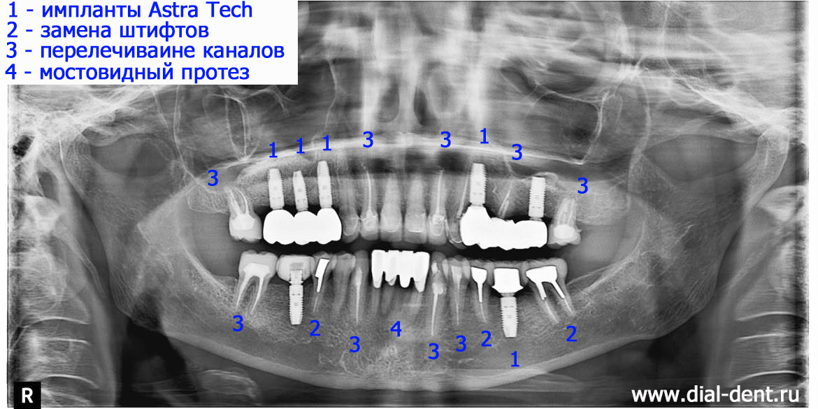 панорамный снимок зубов после комплексного лечения и протезирования