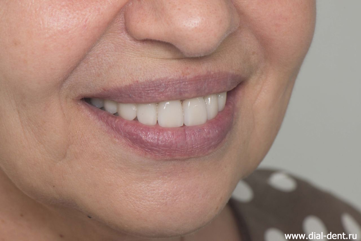 естественная красивая улыбка после протезирования всех зубов керамическими коронками