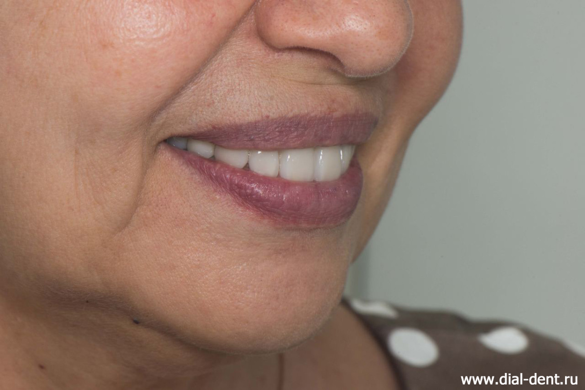 естественная красивая улыбка после протезирования всех зубов керамическими коронками