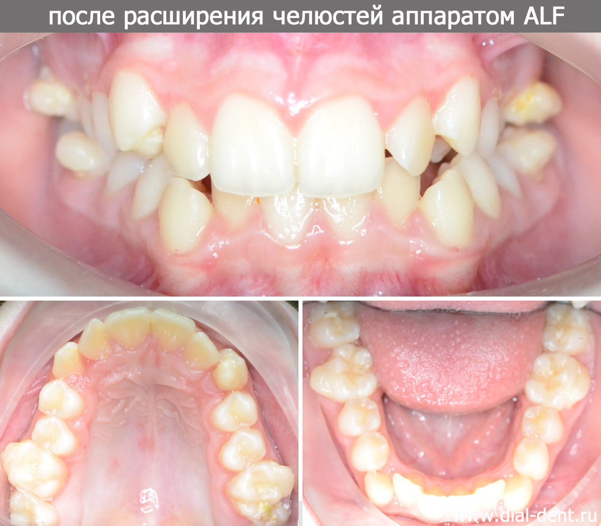 размер обеих челюстей увеличен с помощью аппаратов ALF 