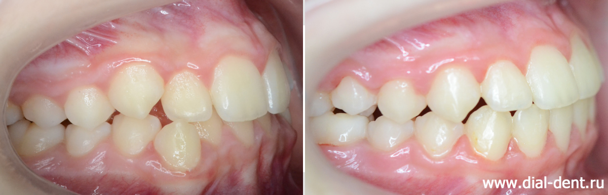 прикус справа до и после ортодонтического лечения