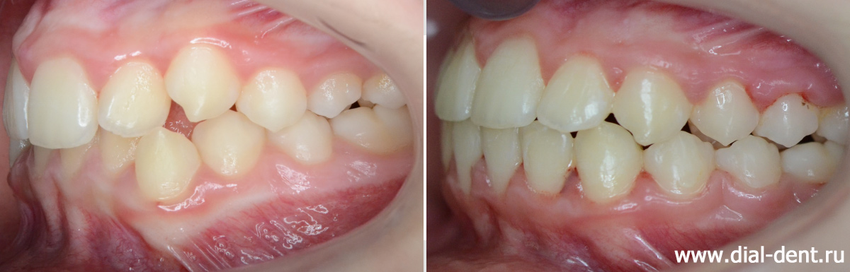 прикус слева до и после ортодонтического лечения