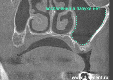 рентген пазух носа после лечения гайморита