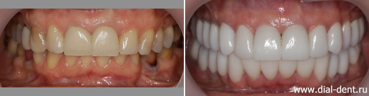 вид зубов до и после комплексного протезирования