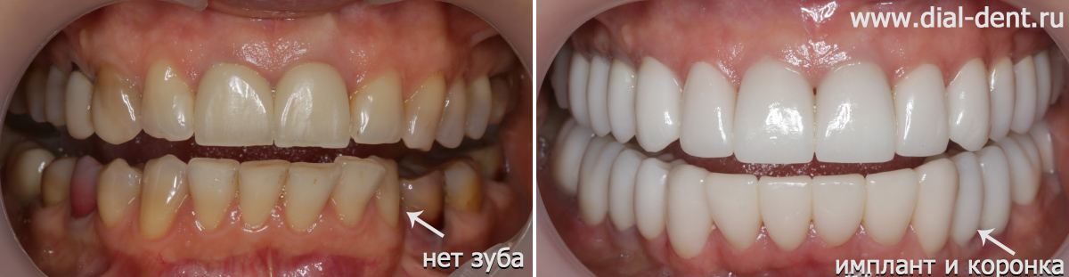 до и после протезирования с восстановлением отсутствующего зуба