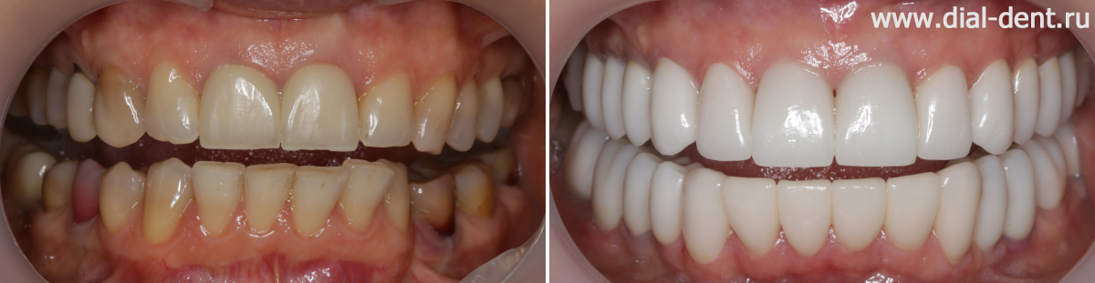 до и после комплексного лечения и протезирования зубов