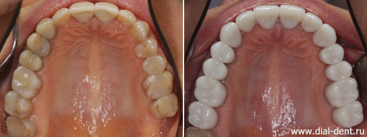 верхние зубы до и после протезирования керамикой