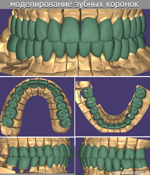 цифровое моделирование зубных коронок