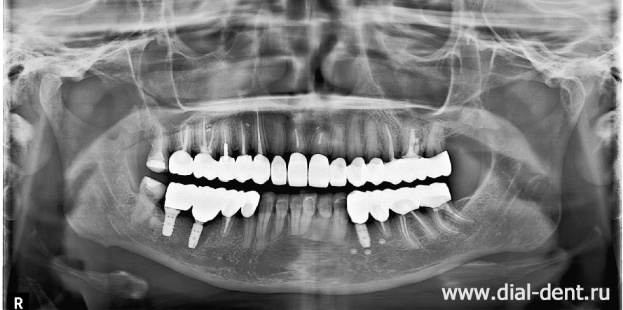 панорамный снимок зубов после перелечивания каналов, имплантации и протезирования