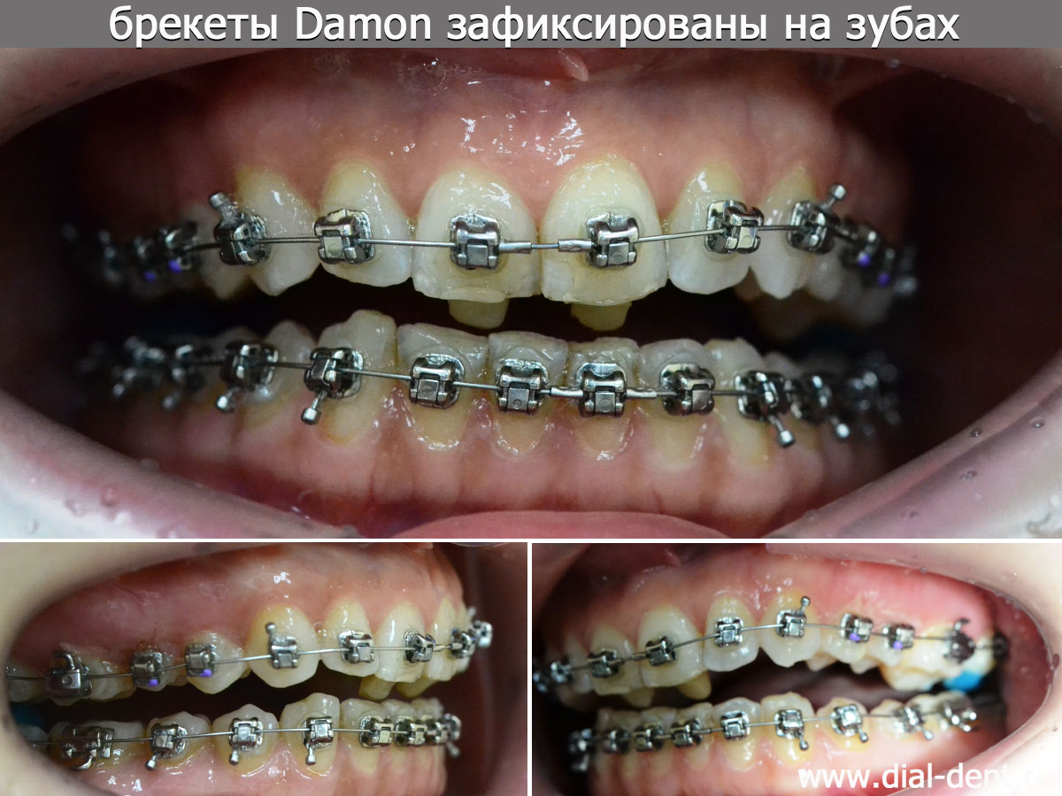 брекеты Damon зафиксированы на зубах