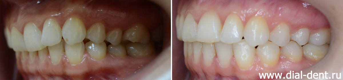 прикус слева до и после ортодонтического лечения