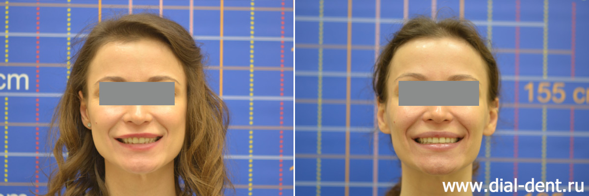 улыбка до и после ортодонтического лечения