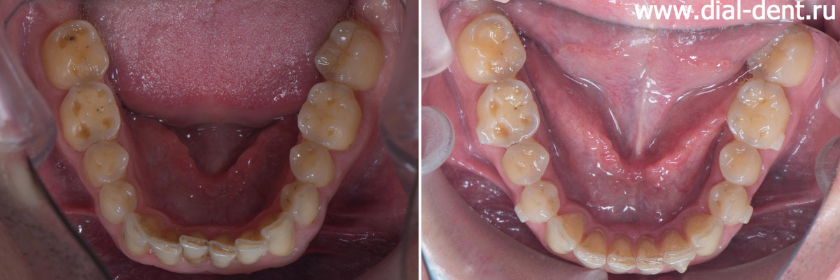 вид нижних зубов до и после ортодонтической подготовки