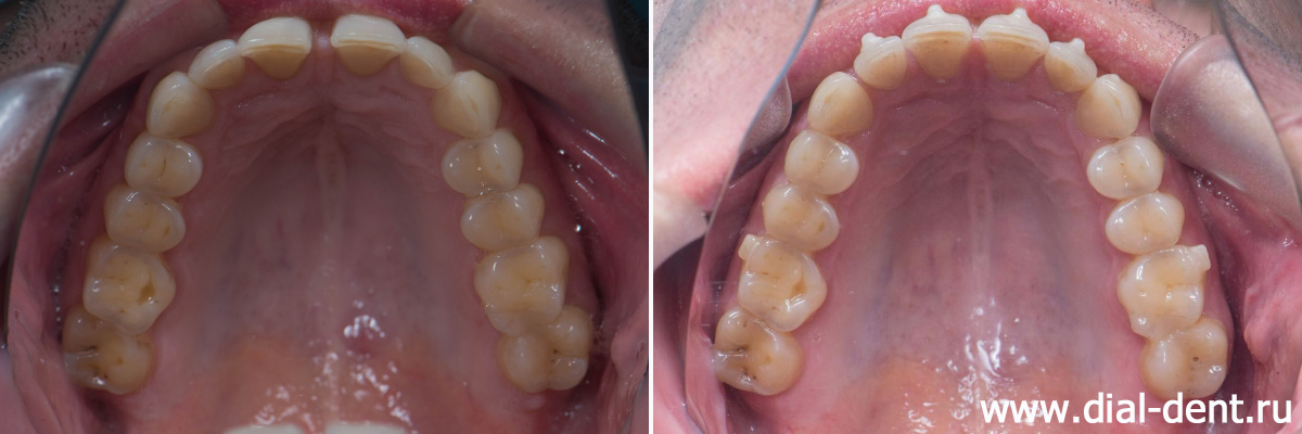 вид верхних зубов до и после ортодонтической подготовки