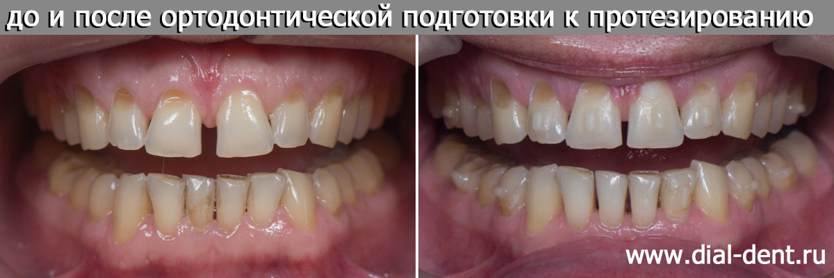 вид зубов до и после ортодонтической подготовки