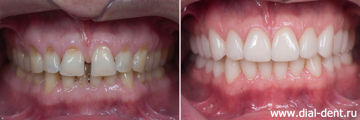 до и после полного протезирования зубов керамическими коронками