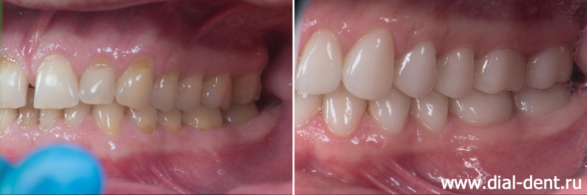 вид зубов слева до и после протезирования всех зубов керамикой