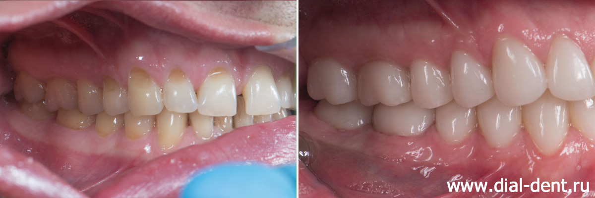 вид зубов справа до и после протезирования всех зубов керамикой