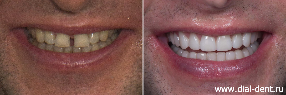 улыбка до и после протезирования зубов керамическими коронками