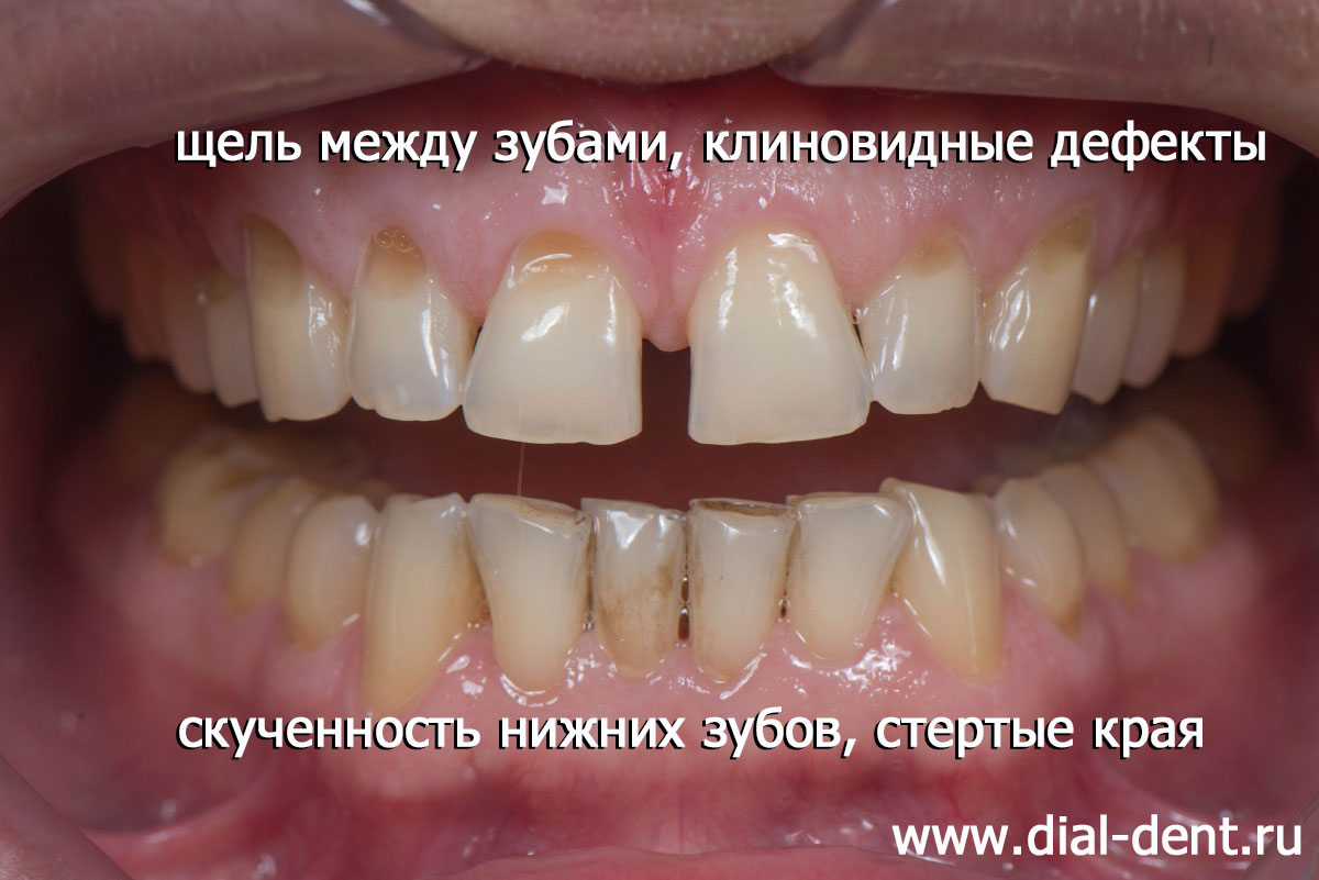 вид зубов до протезирования