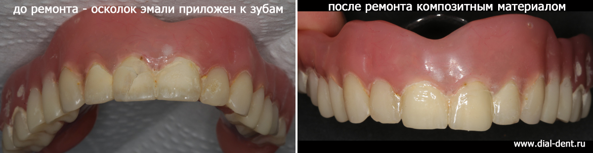 скол эмали на зубном протезе - до и после ремонта
