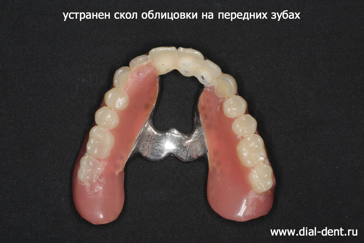 ремонт скола эмали передних зубов на зубном протезе