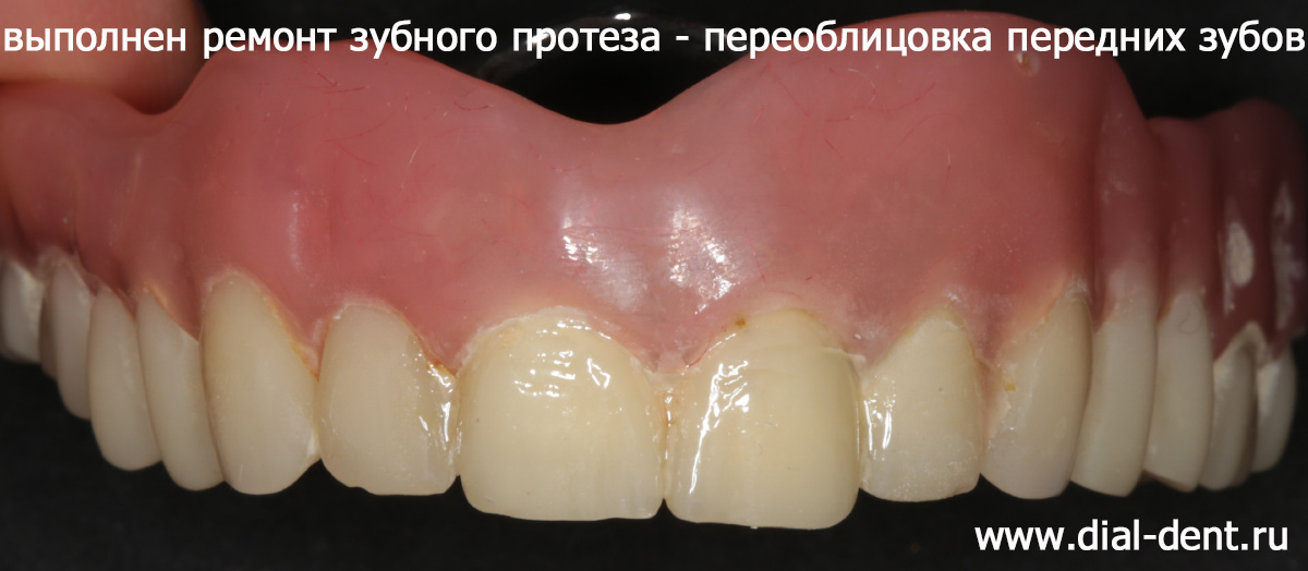 вид зубного протеза после ремонта 