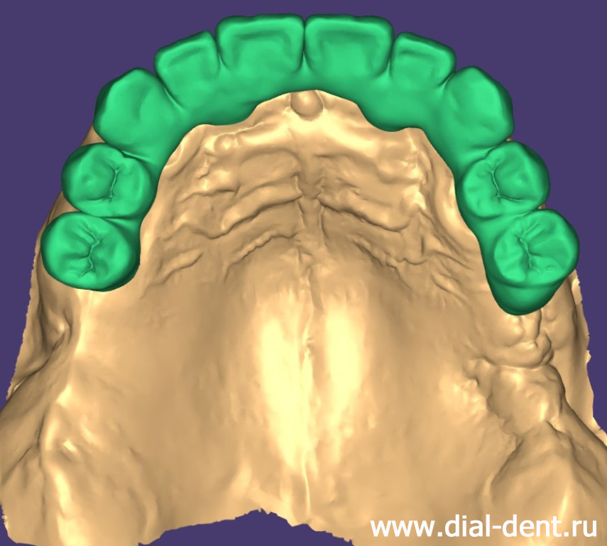 моделирование временного зубного протеза на 4 имплантах