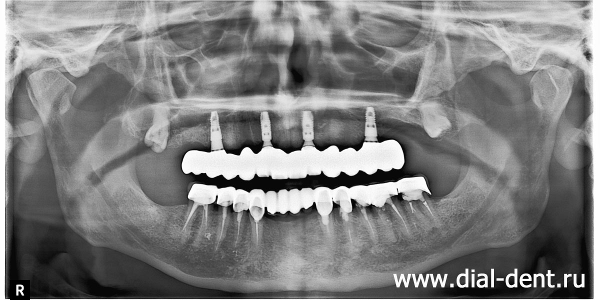 панорамный снимок зубов после окончательного протезирования на имплантах