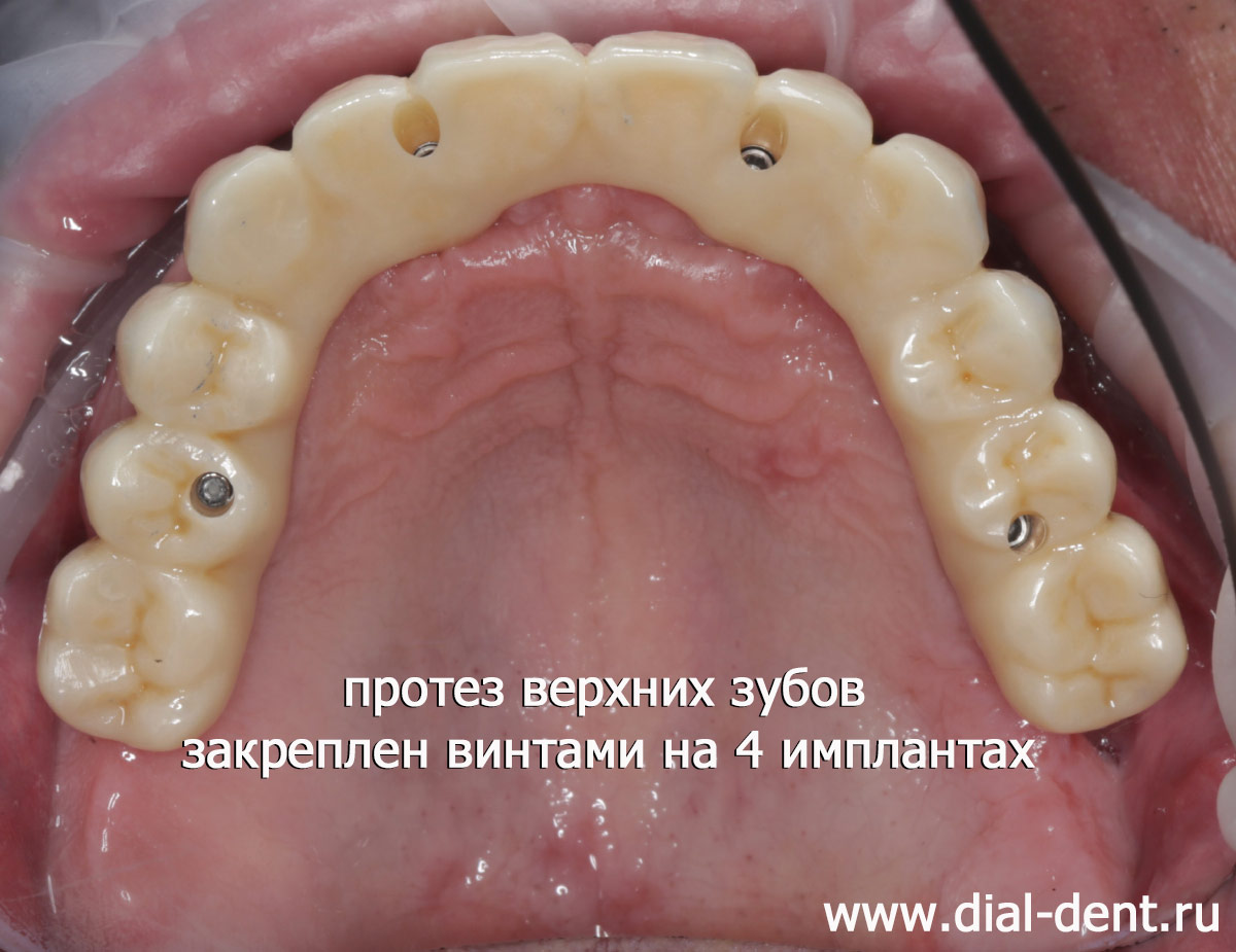 протез верхних зубов на 4 имплантах