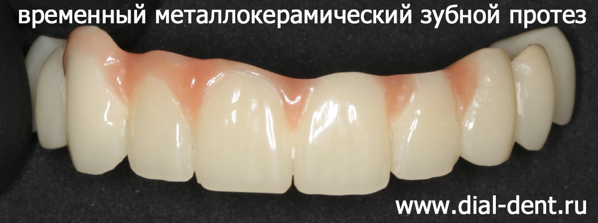 временный металлокерамический протез с опорой на 2 зуба