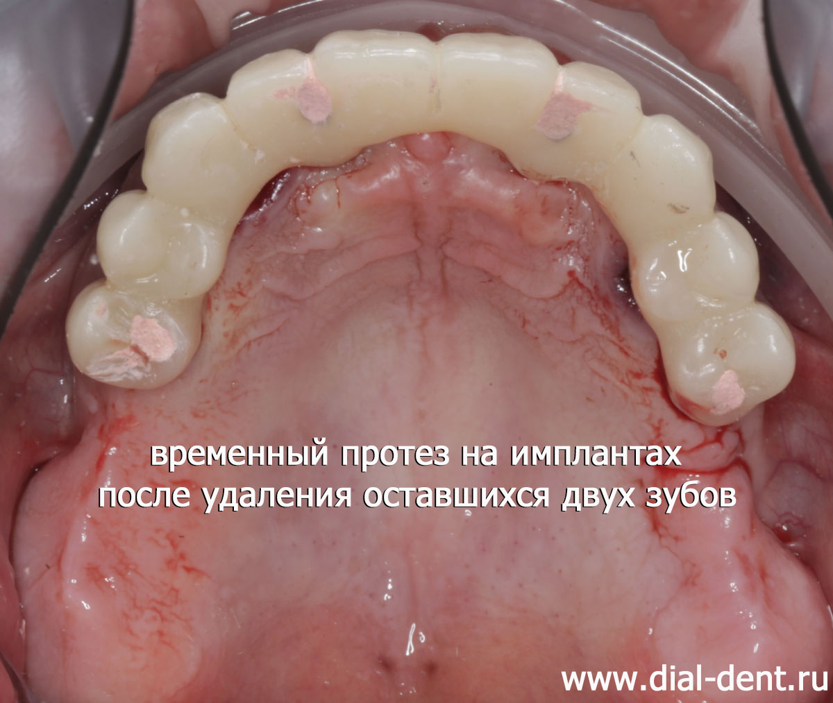 временный зубной протез на 4 имплантах