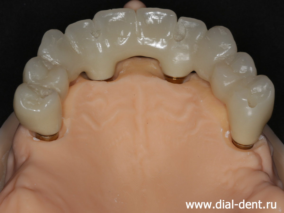 временный зубной протез на 4 имплантах