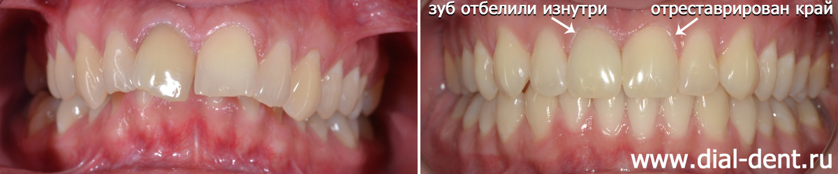 вид зубов до и после исправления прикуса и коррекции