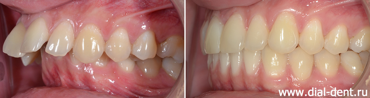 вид в прикусе слева до и после ортодонтического лечения